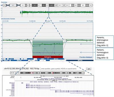 Severe Phenotype in a Patient With Homozygous 15q21.2 Microdeletion Involving BCL2L10, GNB5, and MYO5C Genes, Resembling Infantile Developmental Disorder With Cardiac Arrhythmias (IDDCA)